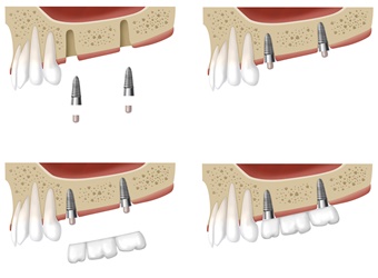 Dental-Bridges-2-1